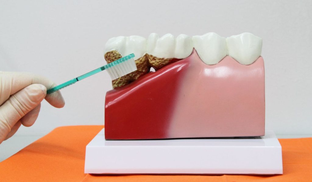 Diagram of damage caused by periodontal disease compared to health tissue and teeth.